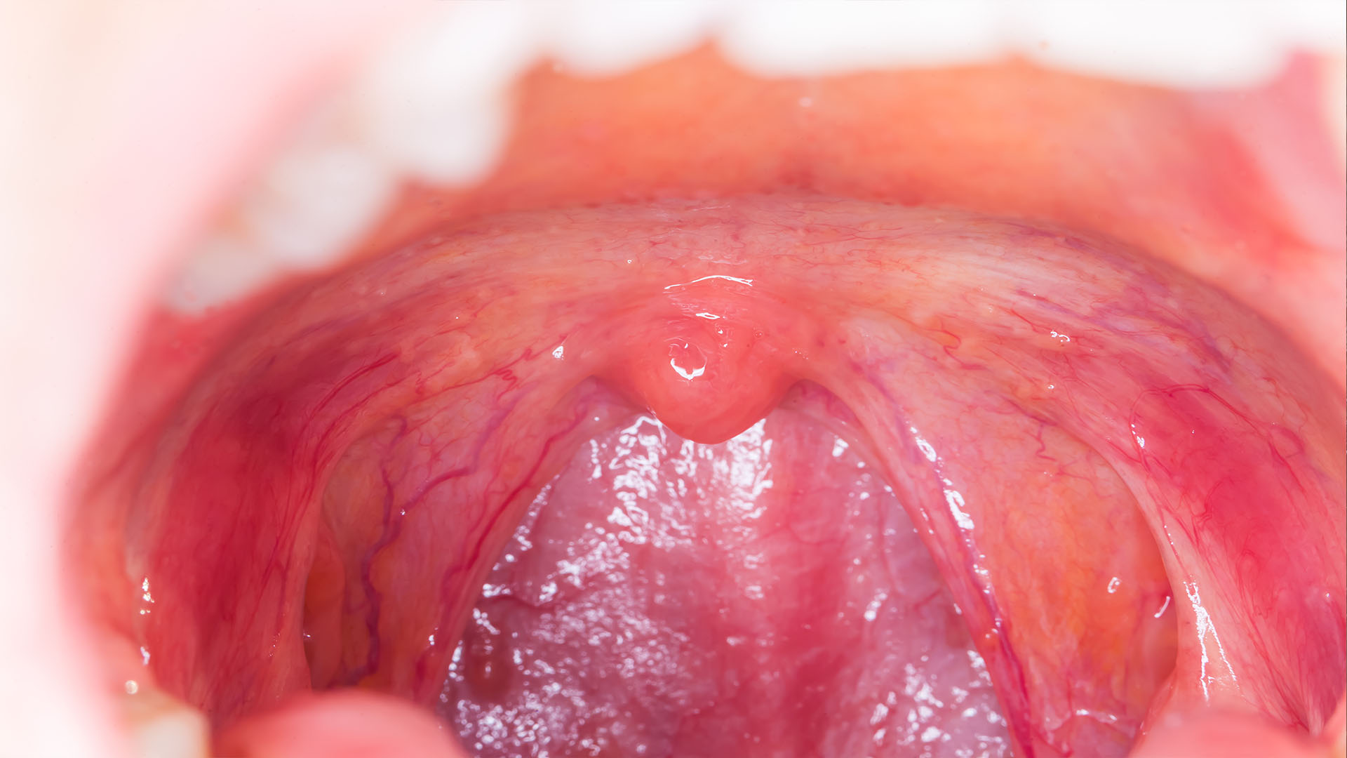 Tonsil & Adenoid Surgery